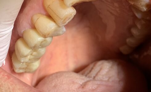 右上567　ジルコニアBr