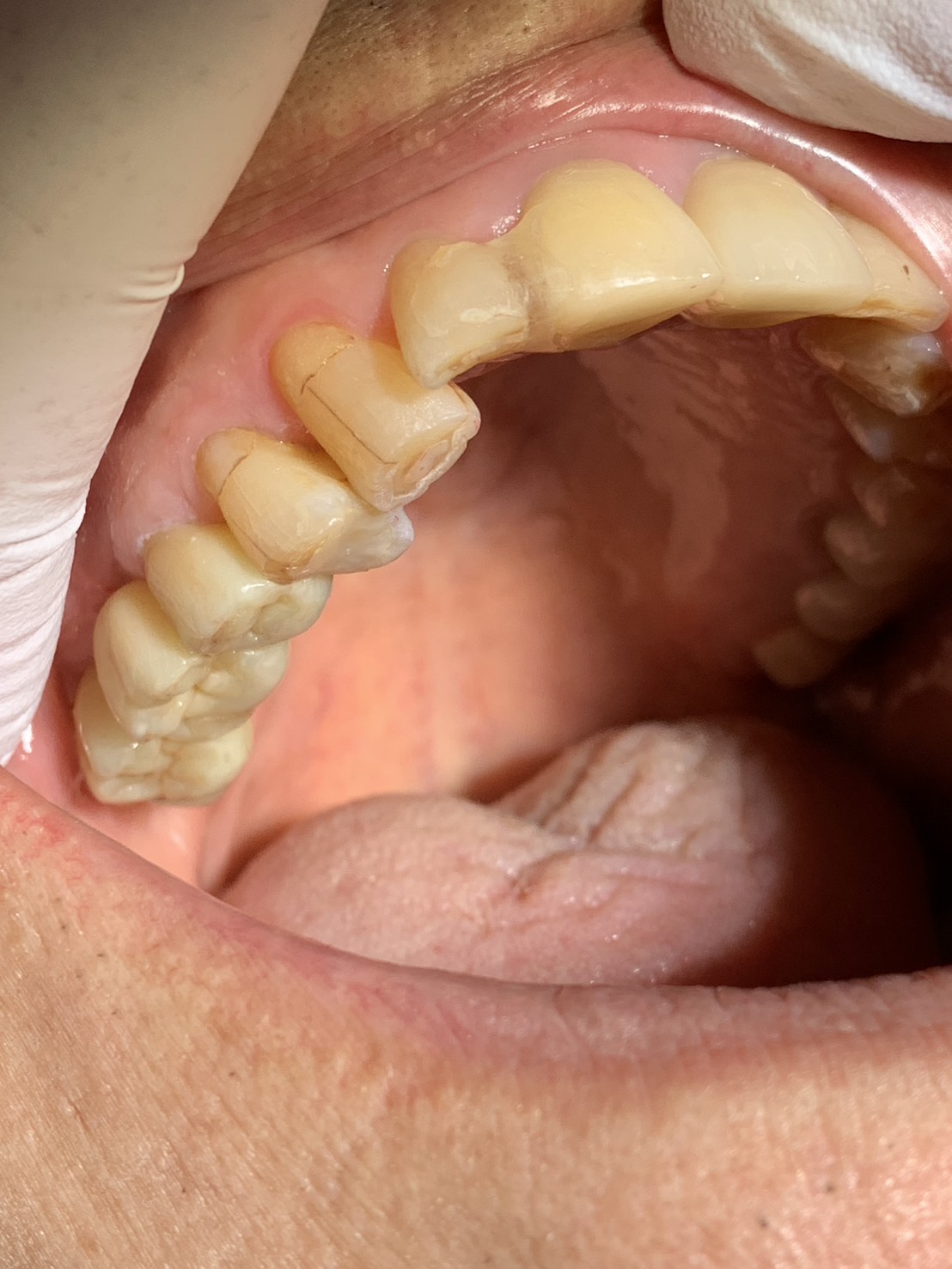 歯科 上顎ジルコニアBr 右上567 ジルコニアBr – 歯科技工所｜Kdental